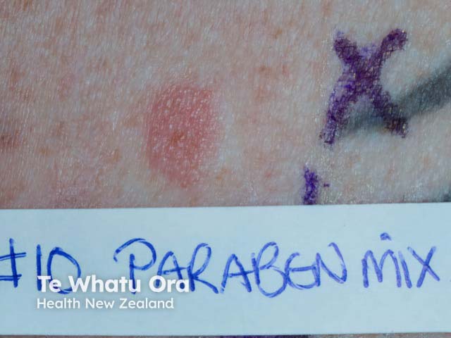 A positive patch test reaction to parabens