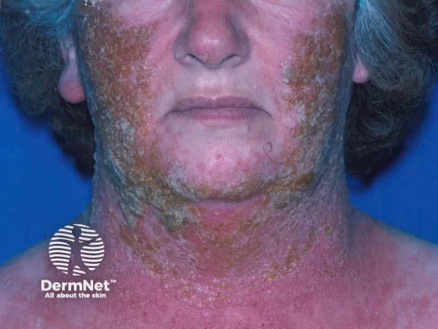 Acute facial contact dermatitis on the face due to parabens in a sunscreen