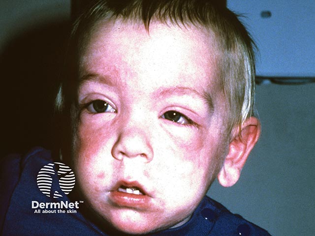 An immediate type 1 reaction after exposure to a rubber balloon; the cheeks and lids have swollen in the last 10 minutes