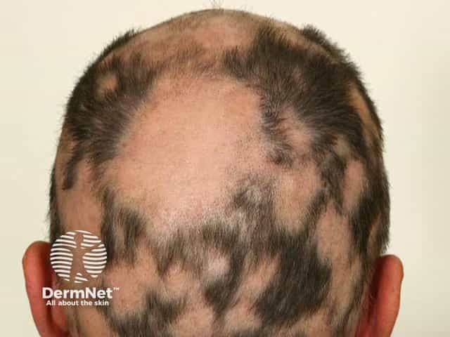 Extensive patchy alopecia areata