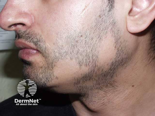 Alopecia areata: beard