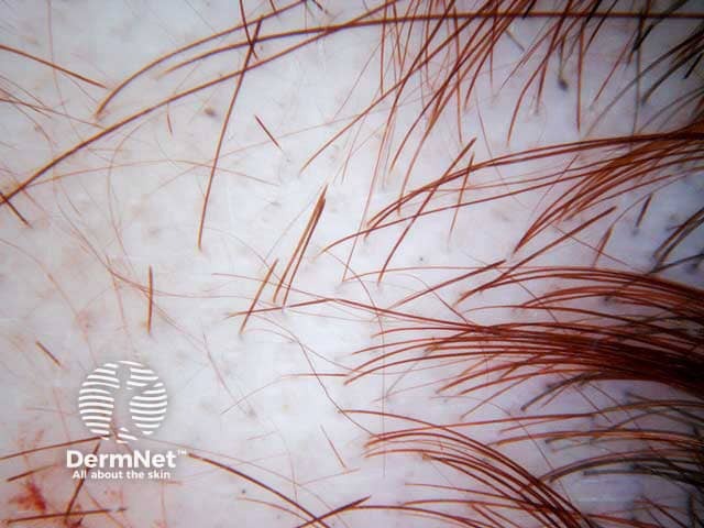 Alopecia areata: dermoscopy