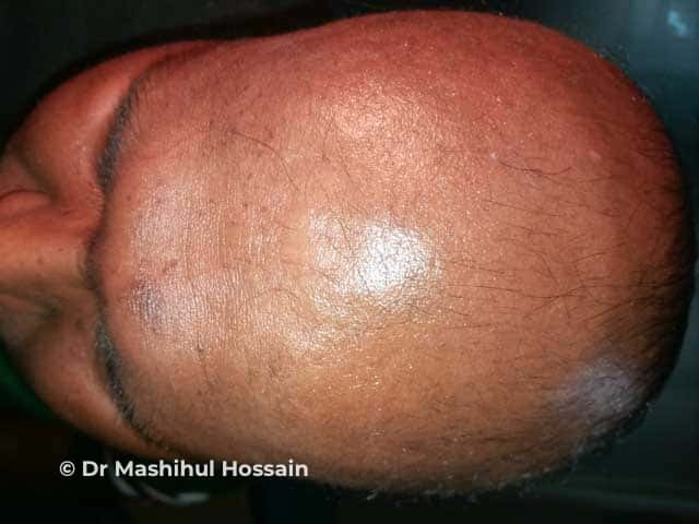 Alopecia totalis