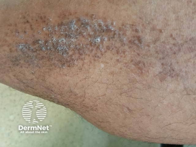 Scaly tan brown papules, some arranged lineraly in lichen amyloidosis on the leg