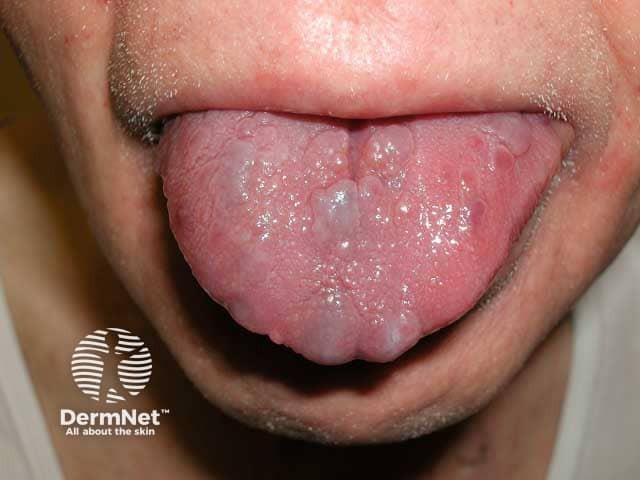 Nodules of amyloid on the tongue due to systemic AL amyloidosis