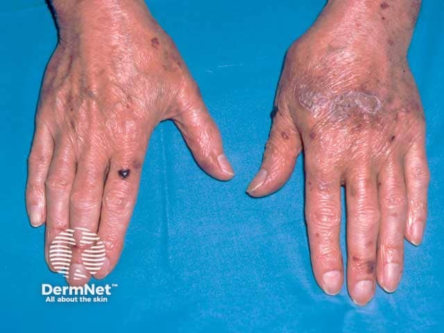 Waxy skin with purpura and a haemorrhagic blister due to systemic AL amyloidosis