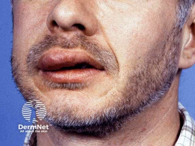 Lip angioedema