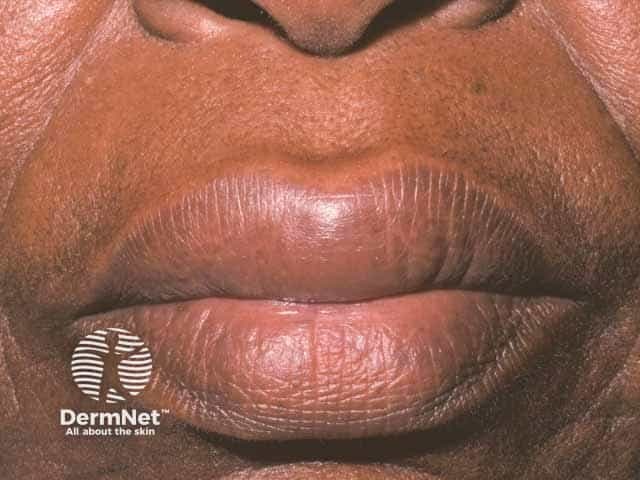 Transient lip oedema due to angioedema