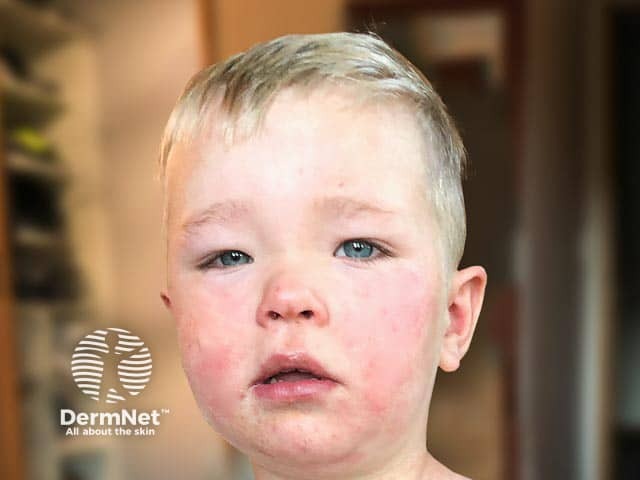 Facial and lid angioedema due to food allergy