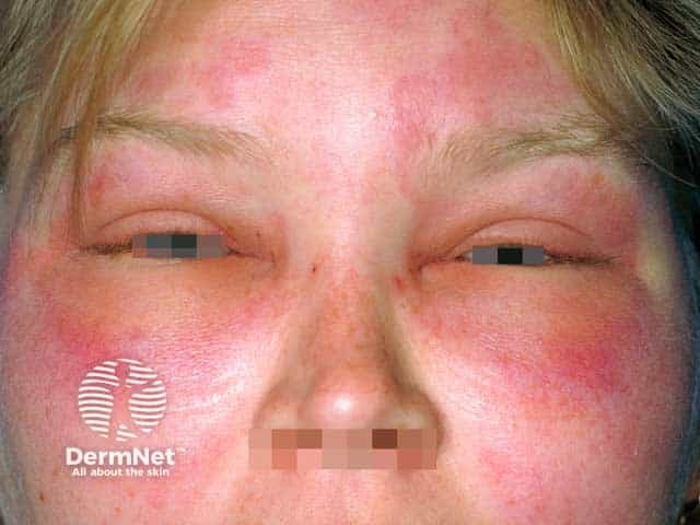 Lid angioedema - there was typical urticaria elsewhere on the body