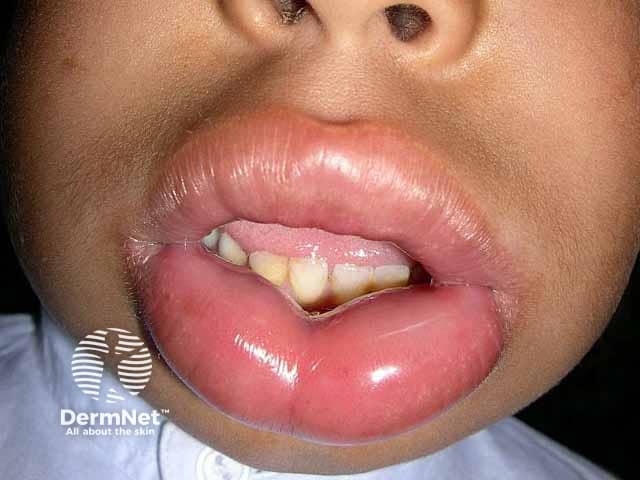 Angioedema