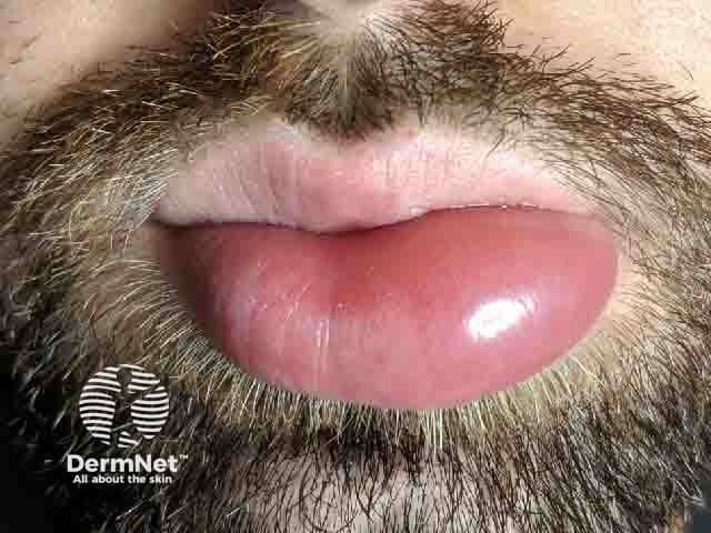 Lip angioedema