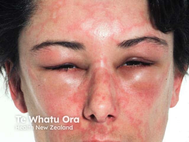 Angioedema and facial urticaria