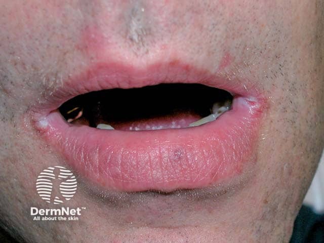 Bilateral angular cheilitis with grey maceration at the angles of the mouth