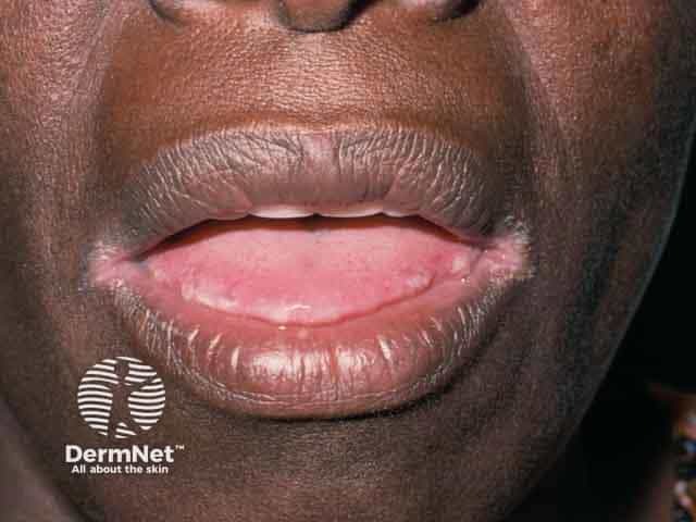 Angular cheilitis in skin of colour