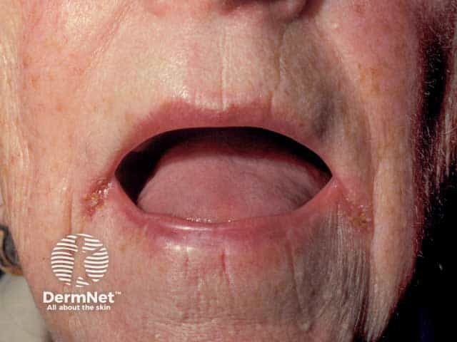 Redness and erosion of the lateral oral skin folds in an edentulous woman