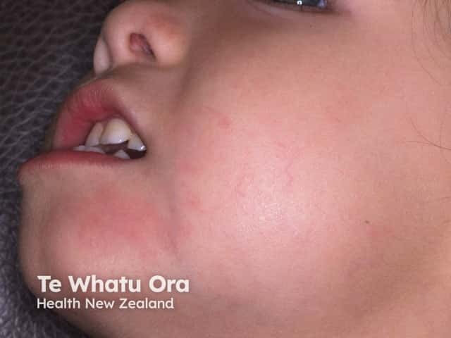 Patchy mild atopic eczema on the chin