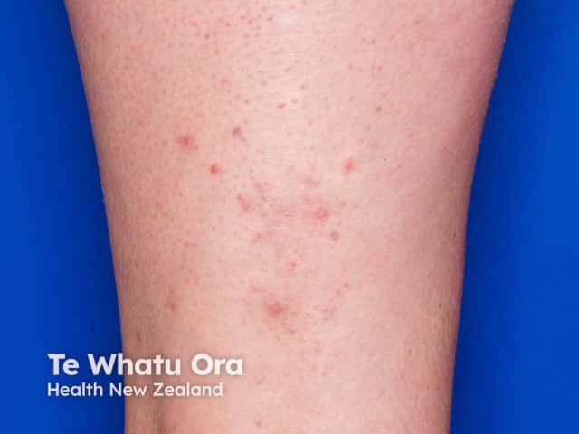 Follicular eczema on the thigh