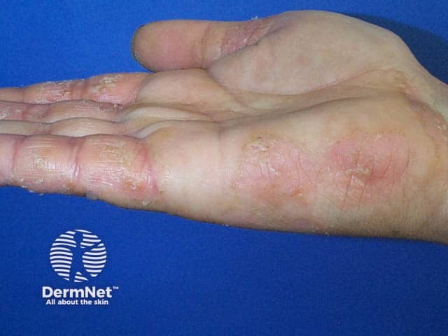 Atopic hand eczema