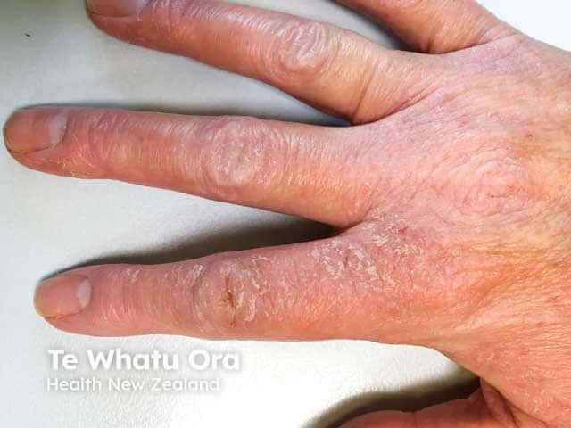 Dry, thickened and fissured dorsal finger eczema in an atopic