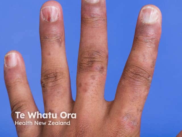 Hyperkeratosis, dryness and hyperpigmentation over the knuckles in atopic hand eczema