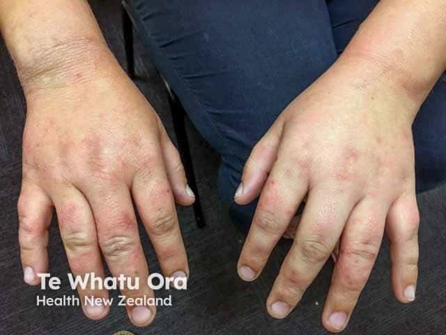 Eczema and skin thickening over the fingers in an atopic