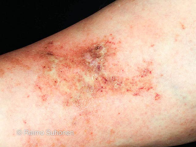 Eczematised atrophie blanche on the shin