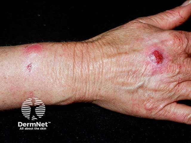 Fish tank granuloma with sporotrichoid spread to the wrist