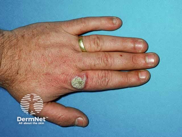 Warty Mycobacterium marinum infection