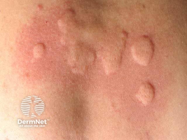 Autoimmune progesterone dermatitis: urticarial pattern