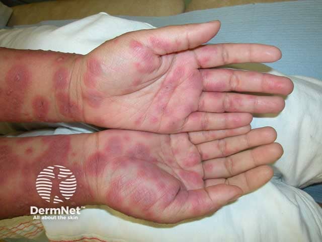 Autoimmune progesterone dermatitis: erythema mulitiforme pattern