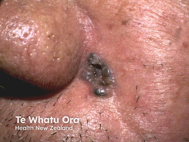 Nodular basal cell carcinoma