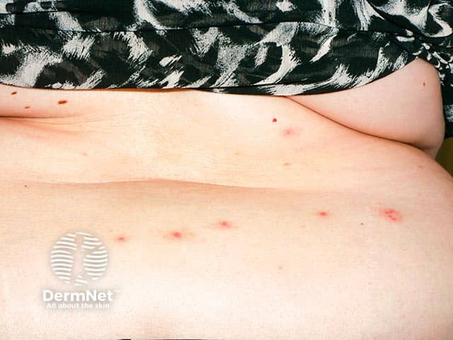 Bed bug bites on the abdomen - they are often grouped in threes