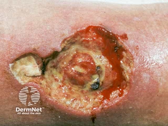 Pyoderma like lesion on the leg in Behcet disease