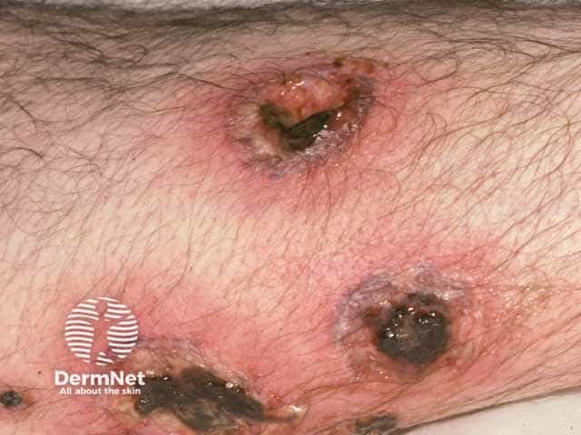 Pyoderma like lesions in Behcet disease