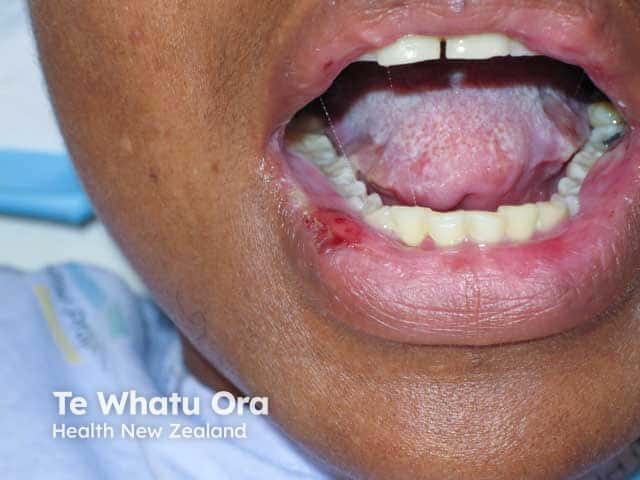 Oral Behcet disease