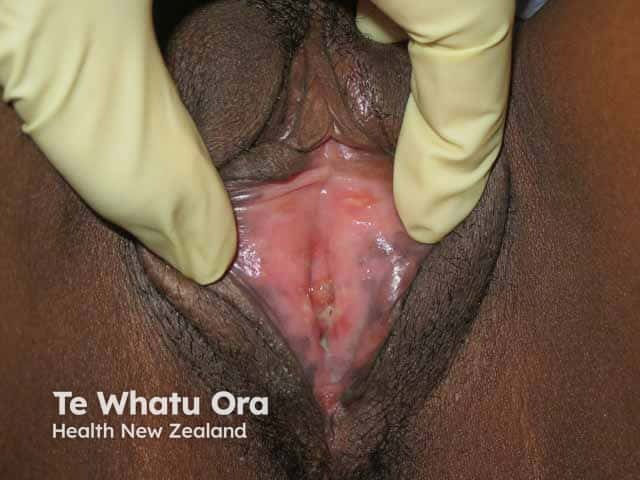 Vulval ulcers in Behcet diease