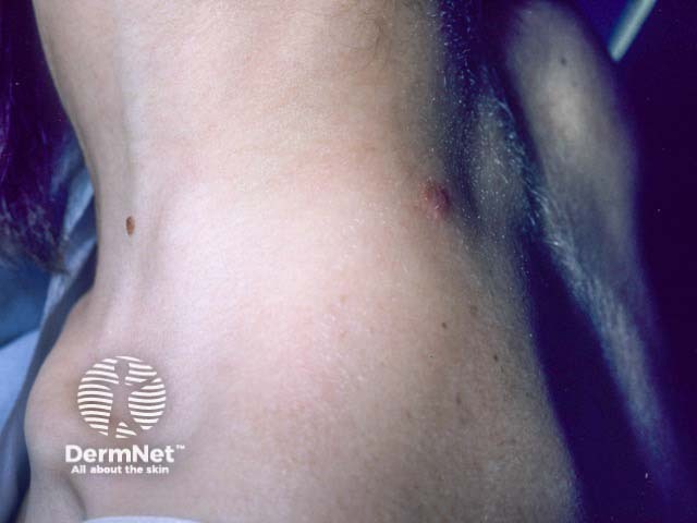 The primary lesion of cat scratch disease on the neck