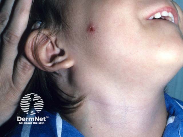 A primary lesion of cat scratch disease on the cheek - note the infra-auricular lymphadenopathy