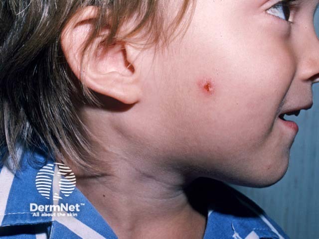 A primary lesion of cat scratch disease on the cheek