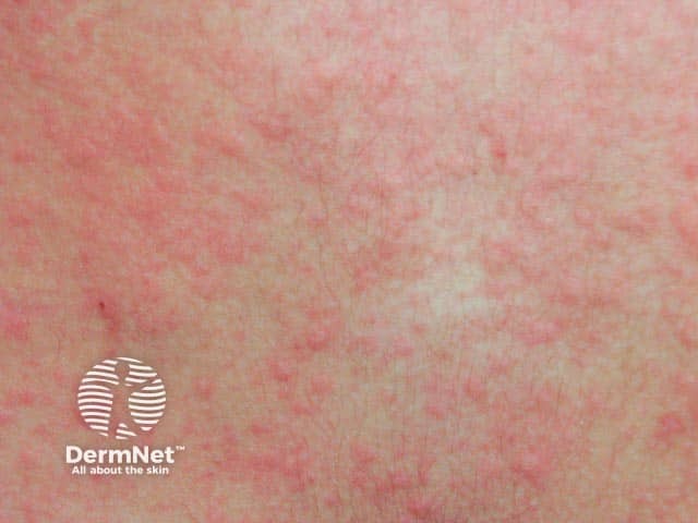 Cholinergic urticaria