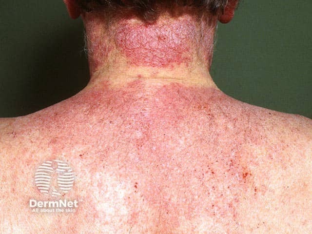 Severe lichenified eczema with sparing under the collar area due to the photoprotection of double fabric 