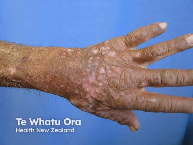 Chronic actinic dermatitis on the dorsal hand - note the cut off at the wrist and relative sparing between the fingers