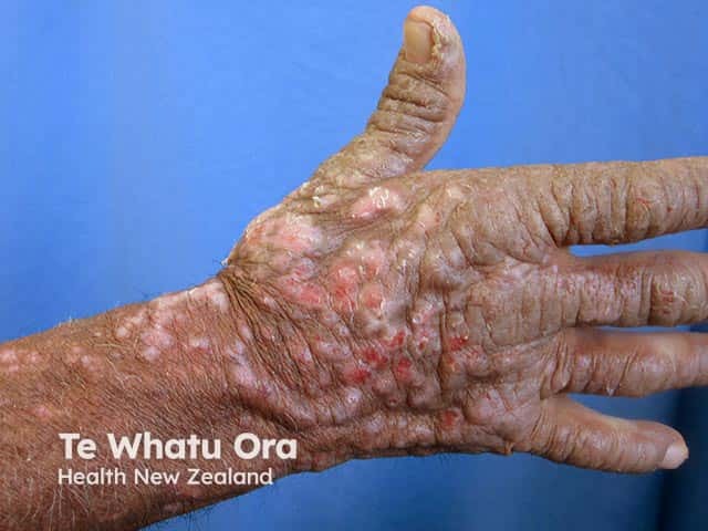 Chronic actinic dermatitis on the dorsal hand - note the cut off at the wrist and relative sparing between the fingers