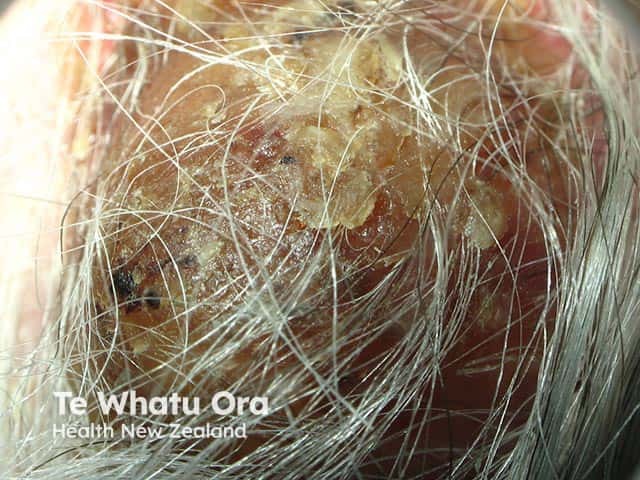 Severe chronic actinic dermatitis on the bald occipital scalp on dermoscopy