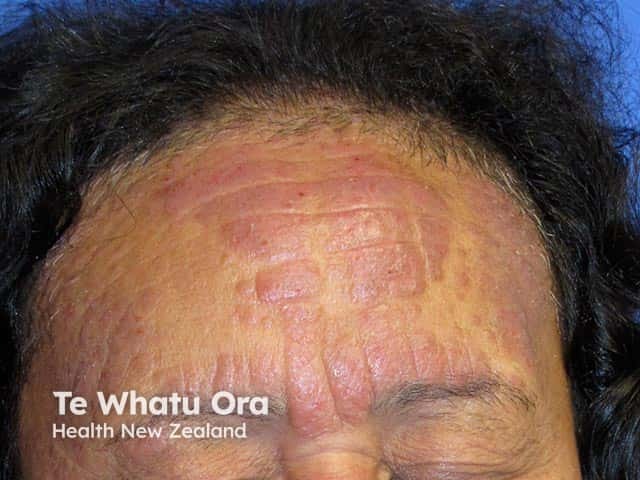 Redness and thickening of eczematous skin on the forehead due to chronic actinic dermatitis in a Maori woman