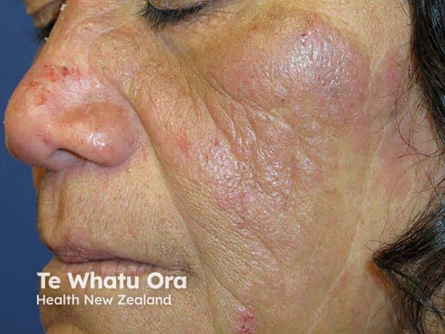 Redness and thickening of eczematous skin on the cheeks and nose due to chronic actinic dermatitis in a Maori woman