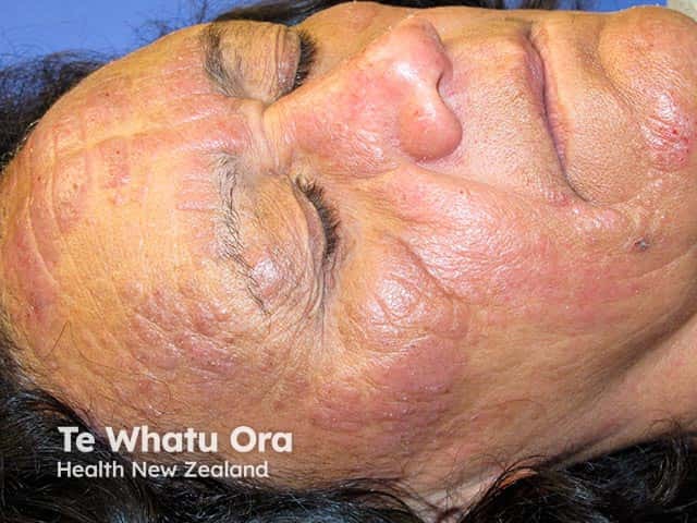 Redness and thickening of eczematous skin on the forehead, cheeks and nose due to chronic actinic dermatitis in a Maori woman