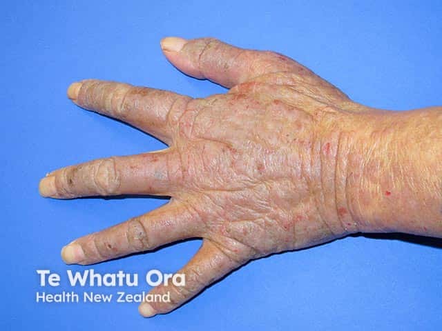 Chronic actinic dermatitis on the dorsal hand - the palms and web spaces show some sparing