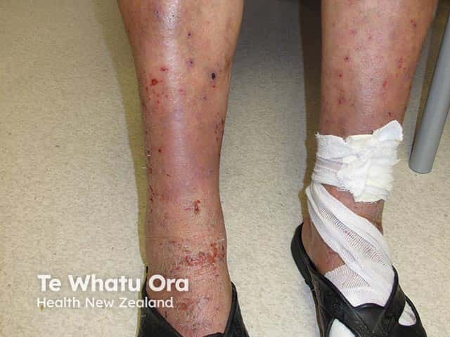 Chronic actinic dermatitis on the lower legs - an uncommon location as it is rare in women, and men will tend to photoprotect by wearing trousers